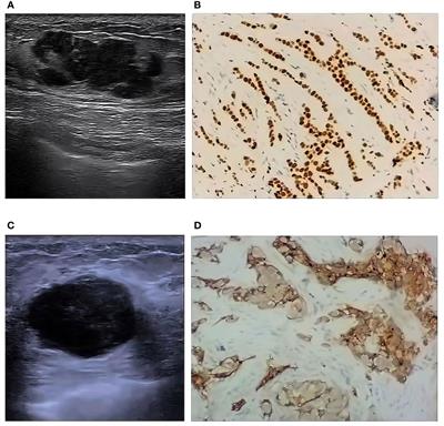 Association between ultrasound BI-RADS signs and molecular typing of invasive breast cancer